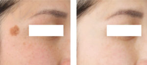 使用画像公開！スーパーフルーツダイエット フルベリの効果・口コミ検証