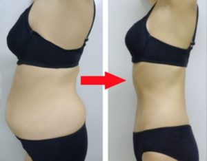 美容整形のバストアップ