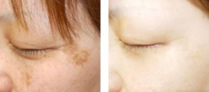 ビハキュア ビューティースキンクリームシミ消し効果はなし？気になる口コミと評判と効果