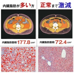 キャビテーションでキレイな体型｜産まれ変わったNEWなワタシ！