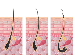 毛根を移植する手術