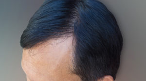 直接毛髪を植え付ける施術