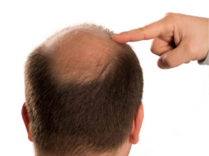 毛髪の移植で薄毛解消